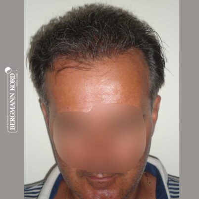 hair-transplantation-bergmann-kord-results-FUT-57030TL-12months-front-001