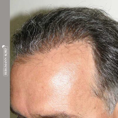 hair-transplantation-bergmann-kord-results-FUT-57030TL-12months-left-001