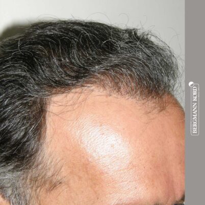 hair-transplantation-bergmann-kord-results-FUT-57030TL-12months-right-001