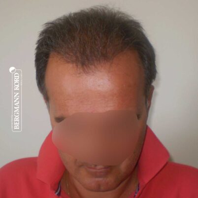 hair-transplantation-bergmann-kord-results-FUT-57030TL-5months-front-001