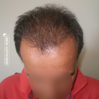 hair-transplantation-bergmann-kord-results-FUT-57030TL-5months-top-001