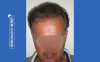 hair-transplantation-bergmann-kord-results-FUT-57030TL-after-001