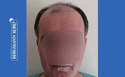 hair-transplantation-bergmann-kord-results-FUT-57030TL-before-001