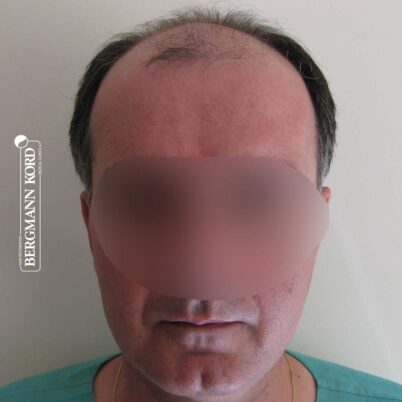 hair-transplantation-bergmann-kord-results-FUT-57030TL-before-front-001