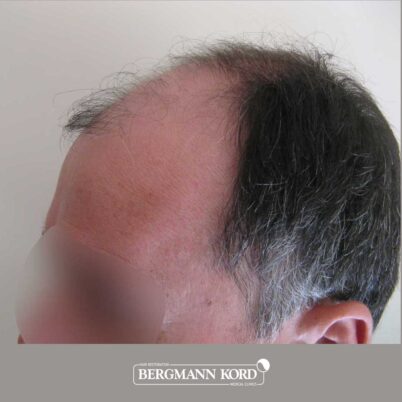 hair-transplantation-bergmann-kord-results-FUT-57030TL-before-left-001