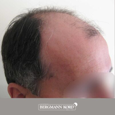 hair-transplantation-bergmann-kord-results-FUT-57030TL-before-right-001