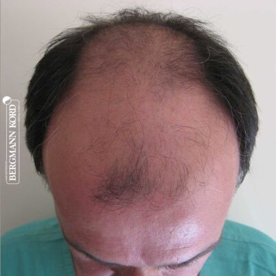 hair-transplantation-bergmann-kord-results-FUT-57030TL-before-top-001