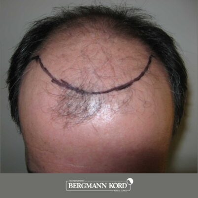 hair-transplantation-bergmann-kord-results-FUT-57030TL-design-001