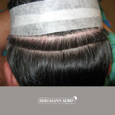 hair-transplantation-bergmann-kord-results-FUT-57030TL-donor-area-001