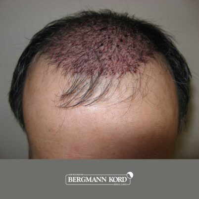 hair-transplantation-bergmann-kord-results-FUT-57030TL-this-day-front-001