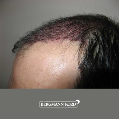 hair-transplantation-bergmann-kord-results-FUT-57030TL-this-day-left-001