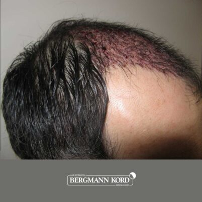 hair-transplantation-bergmann-kord-results-FUT-57030TL-this-day-right-001