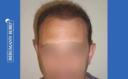 hair-transplantation-bergmann-kord-results-FUT-58054TL-after-001