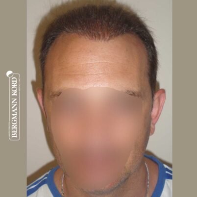 hair-transplantation-bergmann-kord-results-FUT-58054TL-after-front-001