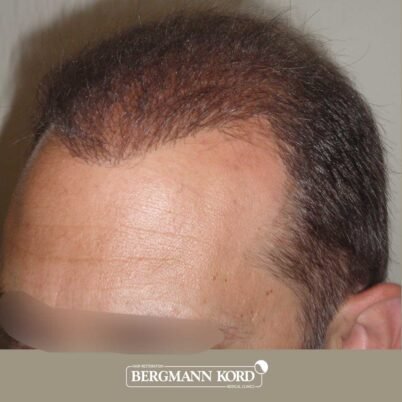 hair-transplantation-bergmann-kord-results-FUT-58054TL-after-left-001