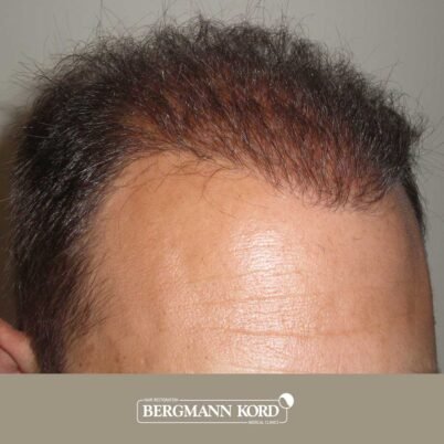 hair-transplantation-bergmann-kord-results-FUT-58054TL-after-right-001