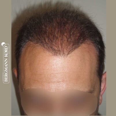 hair-transplantation-bergmann-kord-results-FUT-58054TL-after-top-001