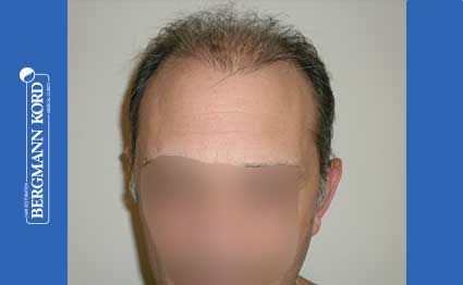 hair-transplantation-bergmann-kord-results-FUT-58054TL-before-001