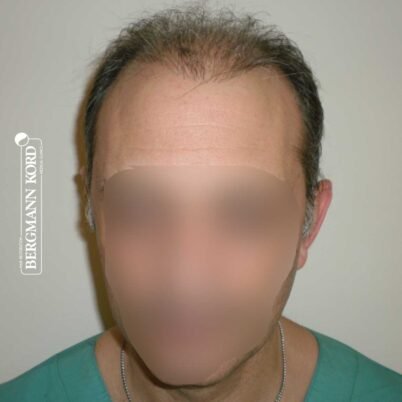 hair-transplantation-bergmann-kord-results-FUT-58054TL-before-front-001