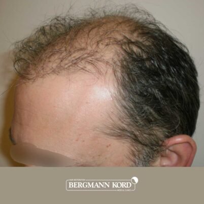 hair-transplantation-bergmann-kord-results-FUT-58054TL-before-left-001