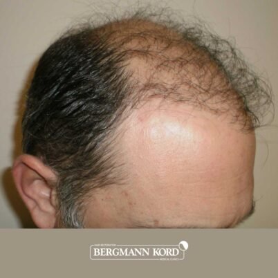 hair-transplantation-bergmann-kord-results-FUT-58054TL-before-right-001