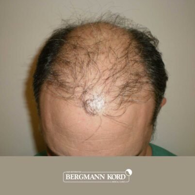 hair-transplantation-bergmann-kord-results-FUT-58054TL-before-top-001