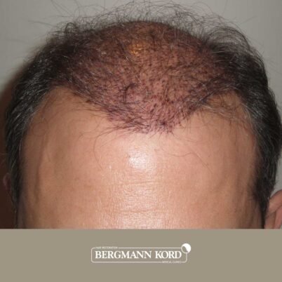 hair-transplantation-bergmann-kord-results-FUT-58054TL-this-day-front-001