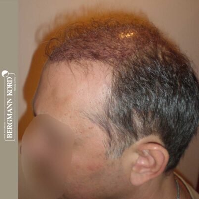 hair-transplantation-bergmann-kord-results-FUT-58054TL-this-day-left-001