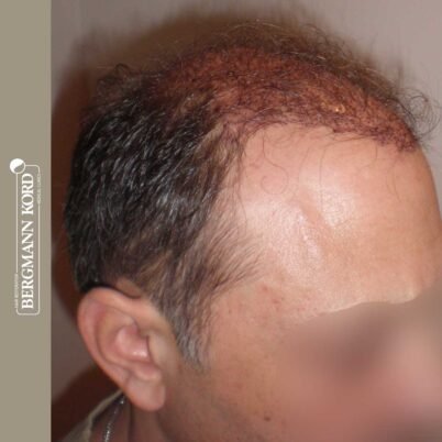 hair-transplantation-bergmann-kord-results-FUT-58054TL-this-day-right-001