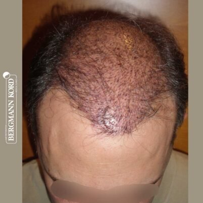 hair-transplantation-bergmann-kord-results-FUT-58054TL-this-day-top-001