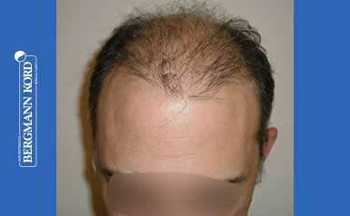 hair-transplantation-bergmann-kord-results-FUT-58054TL-thumb-001