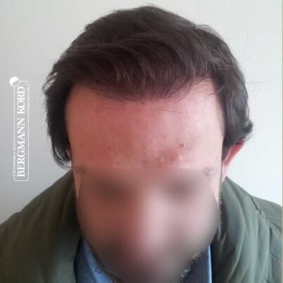 hair-transplantation-bergmann-kord-results-FUT-59033TL-1year-front-001