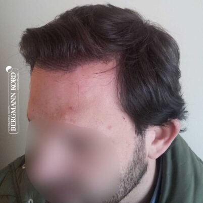 hair-transplantation-bergmann-kord-results-FUT-59033TL-1year-left-001