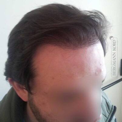 hair-transplantation-bergmann-kord-results-FUT-59033TL-1year-right-001