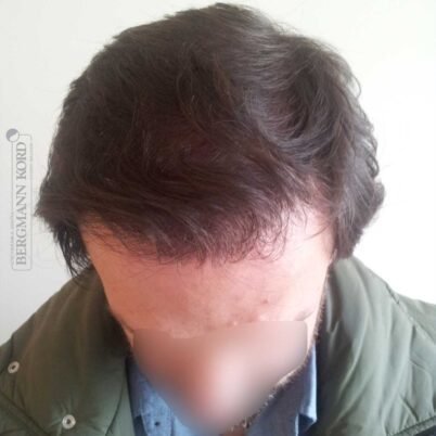 hair-transplantation-bergmann-kord-results-FUT-59033TL-1year-top-001