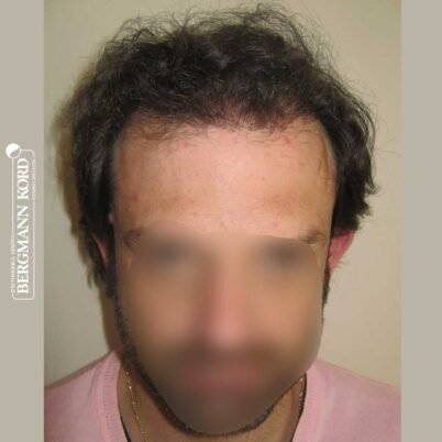 hair-transplantation-bergmann-kord-results-FUT-59033TL-6months-front-001