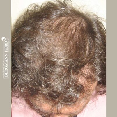 hair-transplantation-bergmann-kord-results-FUT-59033TL-6months-top-001