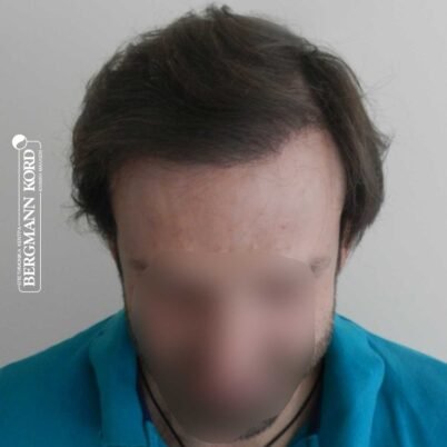 hair-transplantation-bergmann-kord-results-FUT-59033TL-8months-front-001