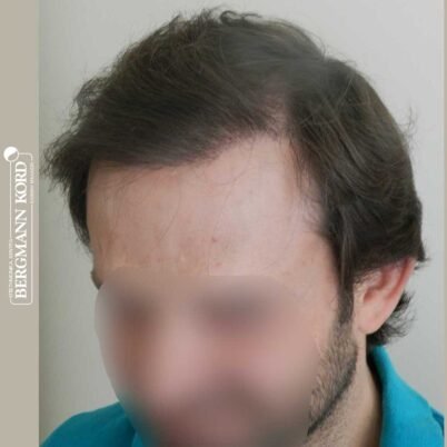 hair-transplantation-bergmann-kord-results-FUT-59033TL-8months-left-001