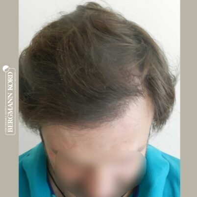 hair-transplantation-bergmann-kord-results-FUT-59033TL-8months-top-001