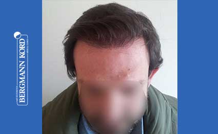 hair-transplantation-bergmann-kord-results-FUT-59033TL-after-001