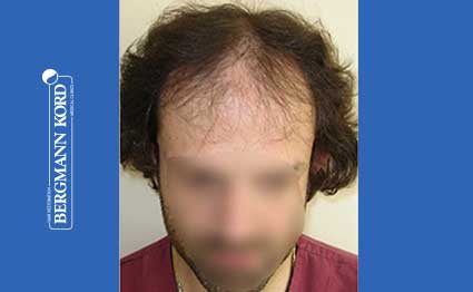 hair-transplantation-bergmann-kord-results-FUT-59033TL-before-001