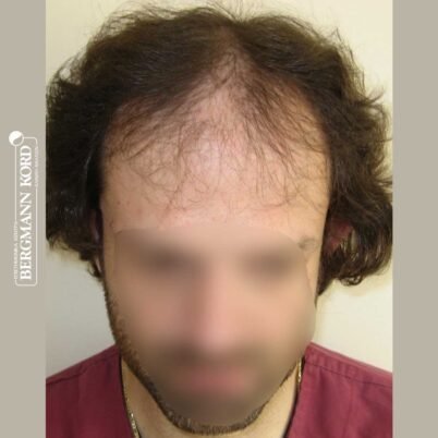 hair-transplantation-bergmann-kord-results-FUT-59033TL-before-front-001