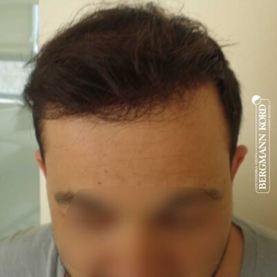 hair-transplantation-bergmann-kord-results-FUT-62017TL-10months-front-001