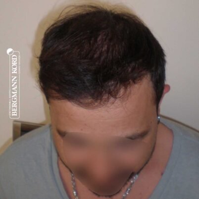 hair-transplantation-bergmann-kord-results-FUT-62017TL-10months-top-001