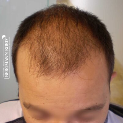 hair-transplantation-bergmann-kord-results-FUT-62017TL-3months-001