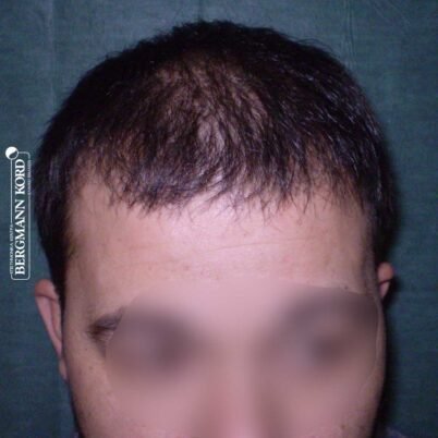 hair-transplantation-bergmann-kord-results-FUT-62017TL-6months-001