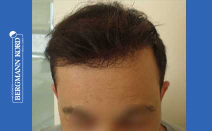 hair-transplantation-bergmann-kord-results-FUT-62017TL-after-001