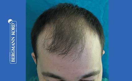 hair-transplantation-bergmann-kord-results-FUT-62017TL-before-001