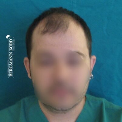 hair-transplantation-bergmann-kord-results-FUT-62017TL-before-front-001